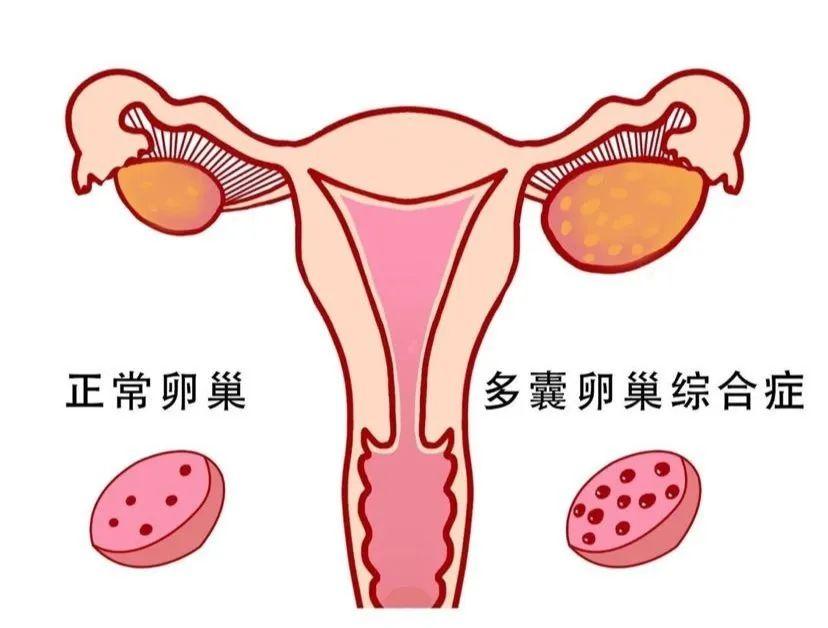 查出多囊卵巢點算？全面解析多囊卵巢綜合症的治療與管理